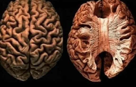 If You don’t Sleep Enough, Your Brain will Start Eating&nbsp;Itself